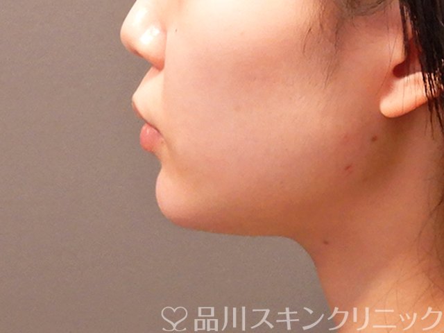 症例NO.69914のAFTER写真