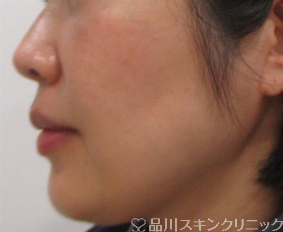 症例NO.25901のAFTER写真