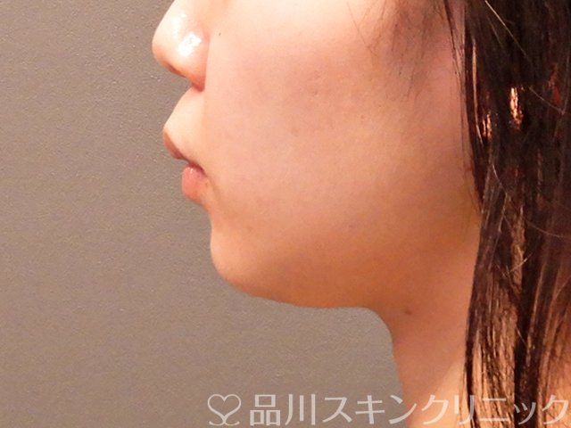 症例NO.69914のBEFORE写真