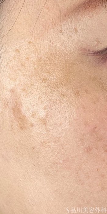 症例NO.72446のAFTER写真