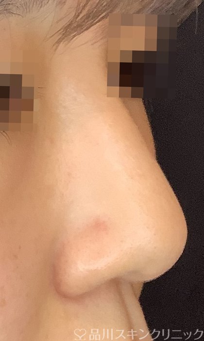 症例NO.69865のBEFORE写真