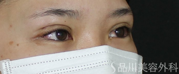 症例NO.72777のAFTER写真