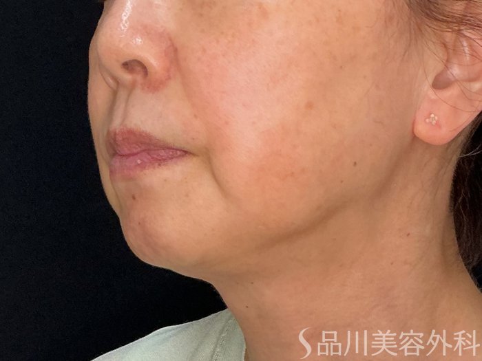 症例NO.71826のBEFORE写真