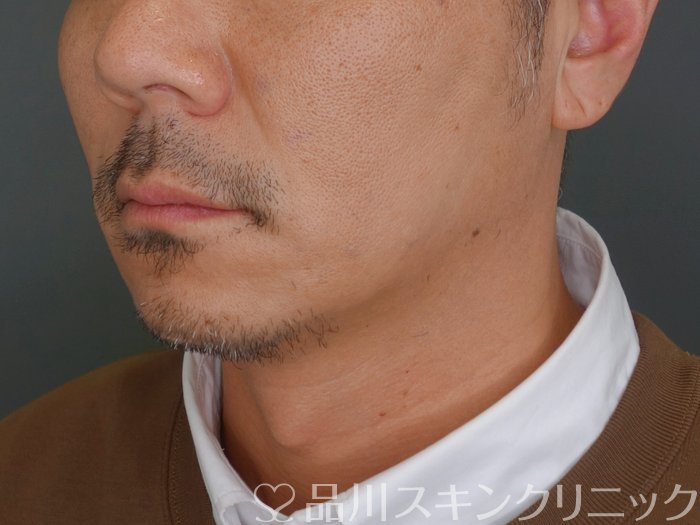 症例NO.72921のAFTER写真