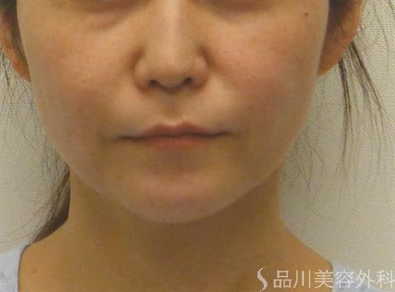症例NO.38692のAFTER写真