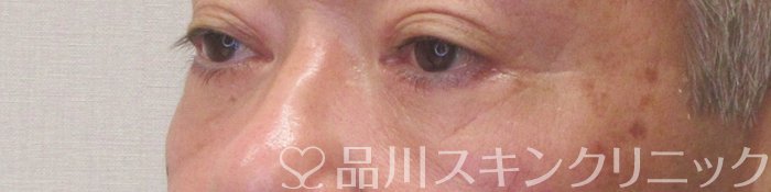 症例NO.70679のAFTER写真