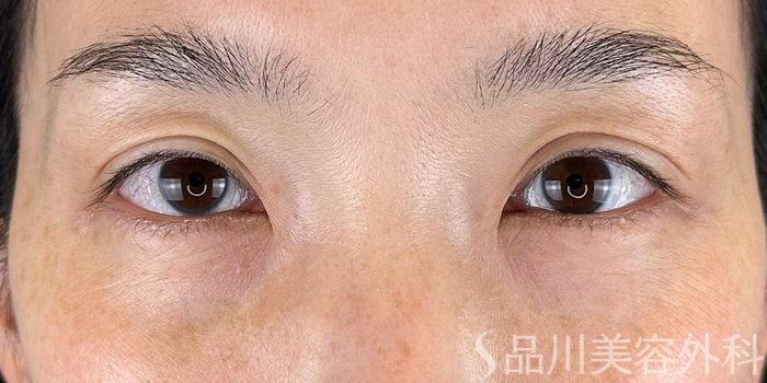症例NO.65590のAFTER写真