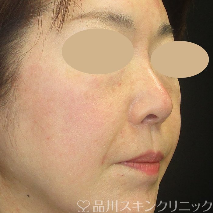 症例NO.73542のAFTER写真