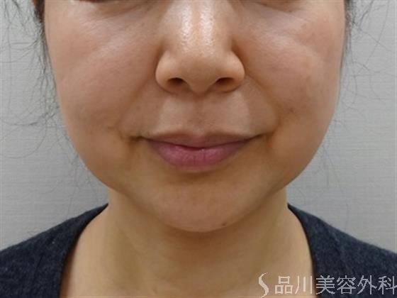症例NO.41918のBEFORE写真