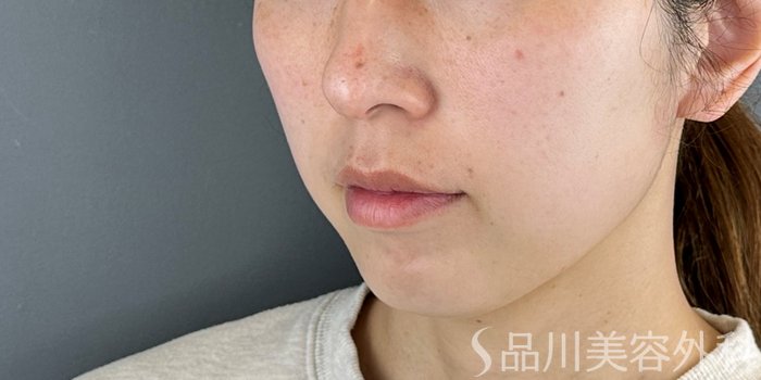 症例NO.69461のBEFORE写真