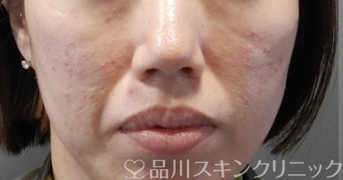 症例NO.65562のAFTER写真