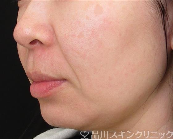 症例NO.57920のBEFORE写真
