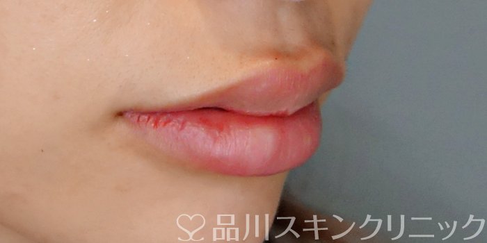症例NO.70899のAFTER写真