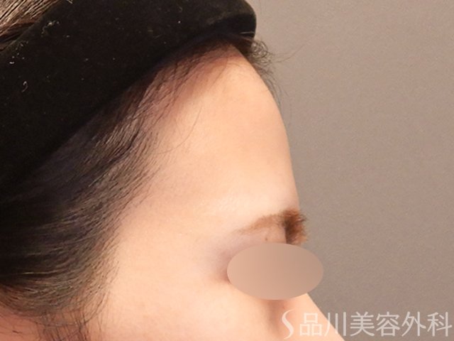 症例NO.72529のBEFORE写真