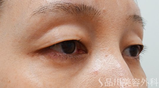 症例NO.70162のBEFORE写真