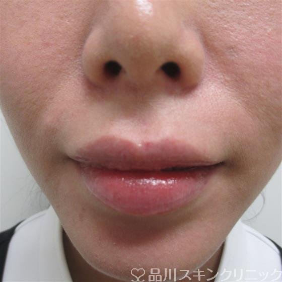 症例NO.26352のBEFORE写真