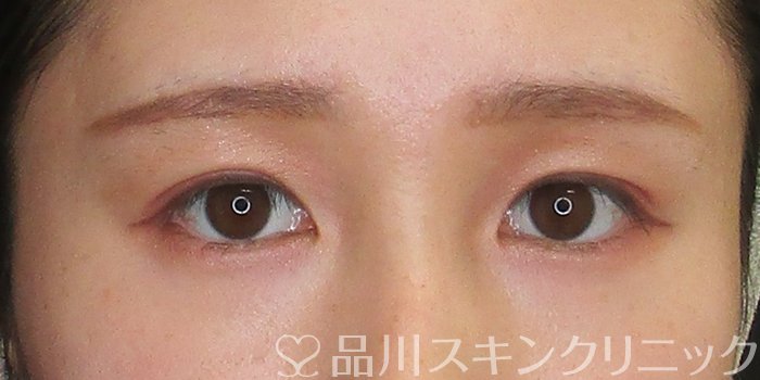 症例NO.75295のAFTER写真