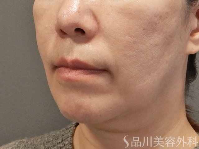 症例NO.73268のAFTER写真