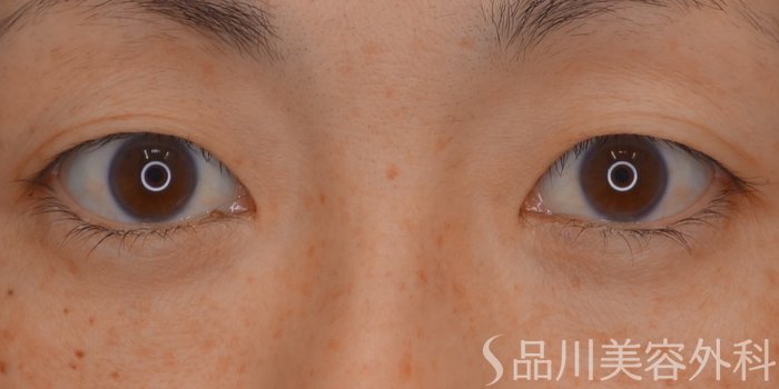 症例NO.65253のBEFORE写真
