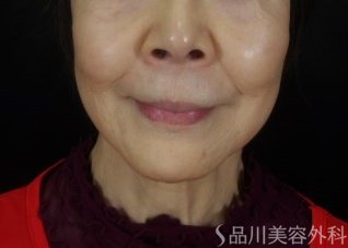 症例NO.72512のBEFORE写真