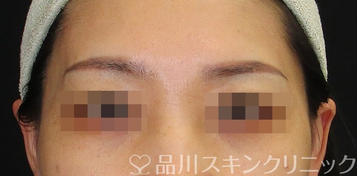 症例NO.74840のBEFORE写真