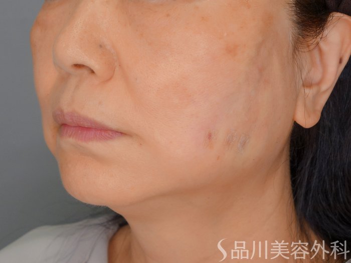 症例NO.73188のAFTER写真