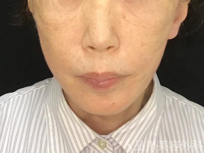 症例NO.71631のAFTER写真