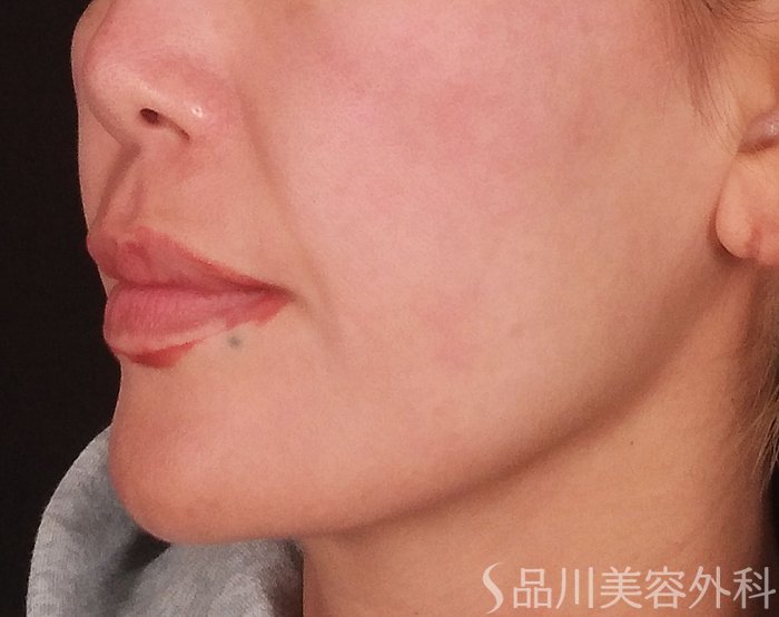 症例NO.70199のBEFORE写真