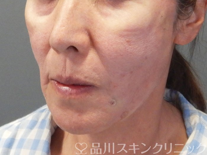 症例NO.69477のAFTER写真