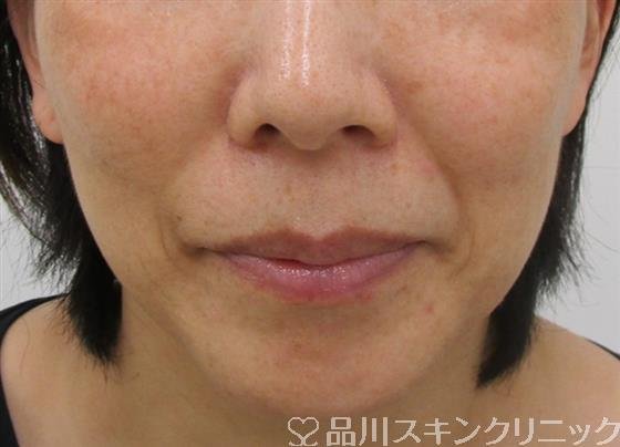 症例NO.37888のBEFORE写真