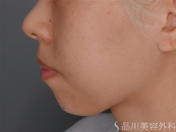 症例NO.52575のAFTER写真