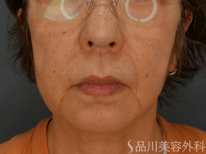症例NO.74636のBEFORE写真
