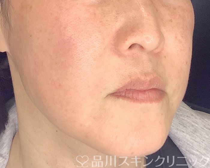 症例NO.69860のAFTER写真