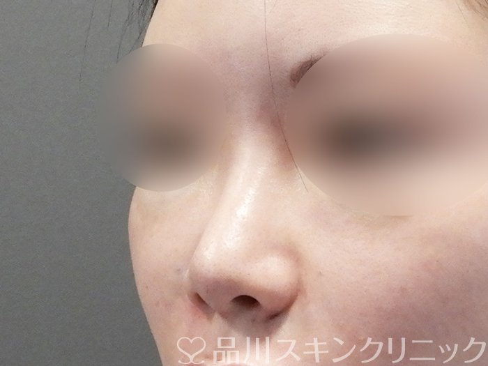 症例NO.72813のAFTER写真