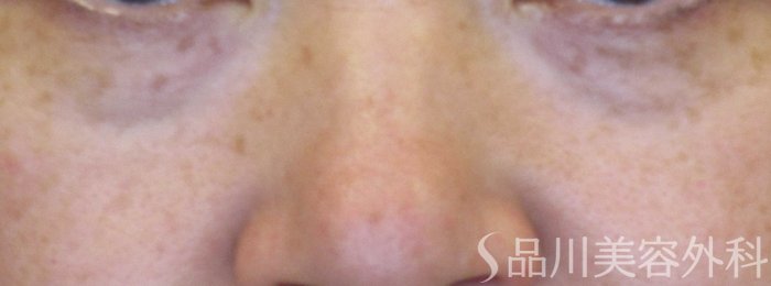 症例NO.71662のBEFORE写真
