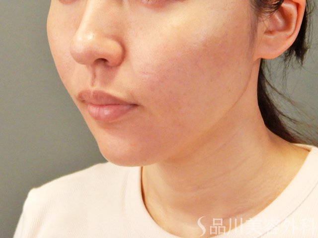 症例NO.64933のAFTER写真