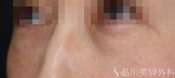 症例NO.61694のBEFORE写真