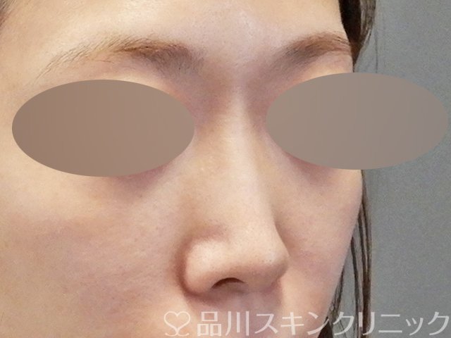 症例NO.64935のBEFORE写真