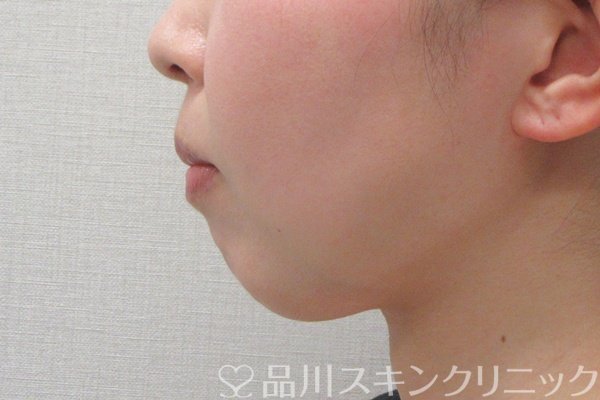 症例NO.74576のBEFORE写真
