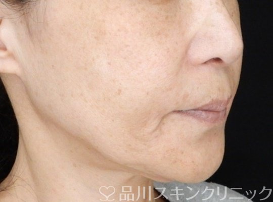 症例NO.70956のBEFORE写真