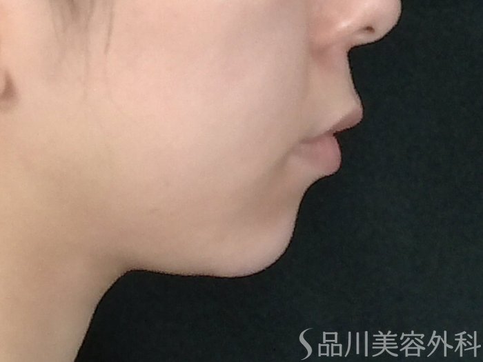 症例NO.70616のBEFORE写真