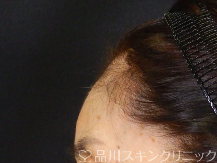 症例NO.65258のAFTER写真