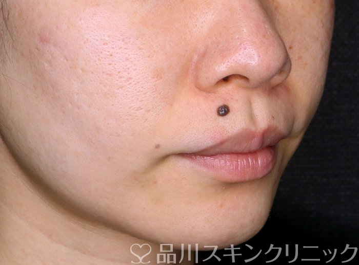 症例NO.63908のAFTER写真