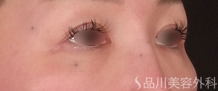 症例NO.69983のBEFORE写真
