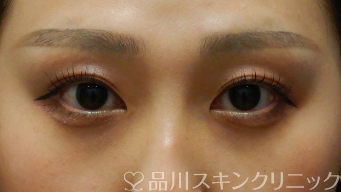 症例NO.64444のAFTER写真