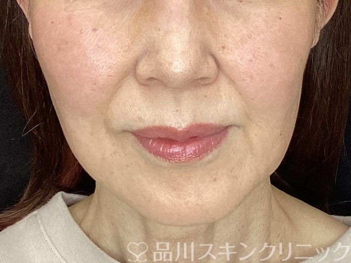 症例NO.72497のBEFORE写真