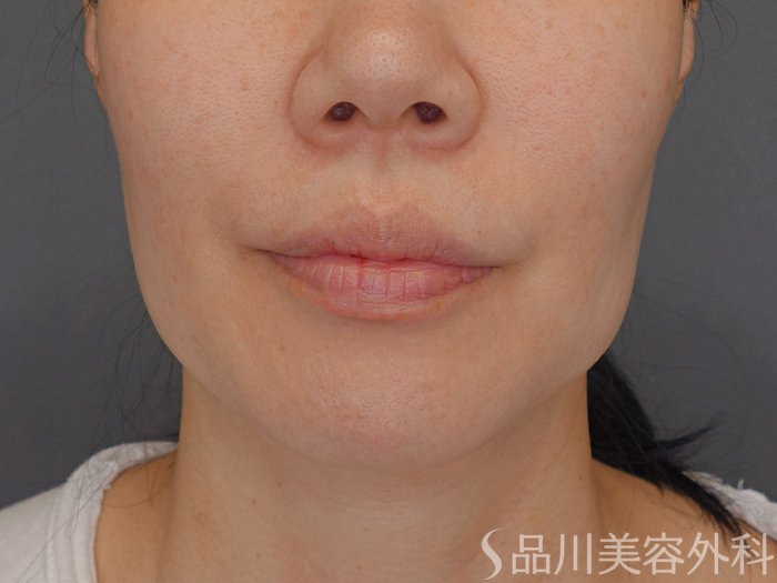 症例NO.70491のBEFORE写真