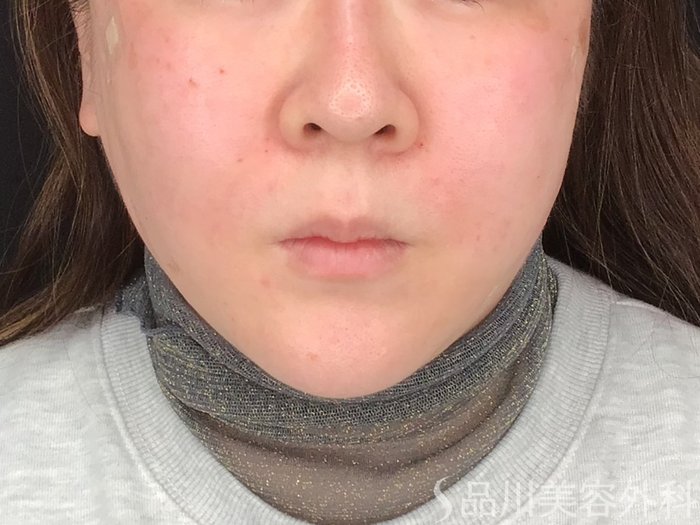 症例NO.64878のAFTER写真