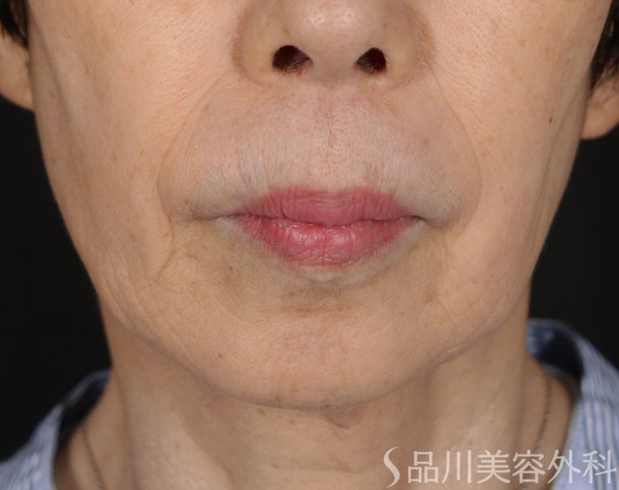 症例NO.71097のBEFORE写真