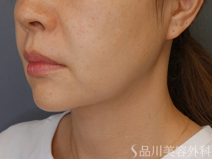 症例NO.71323のBEFORE写真
